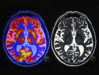 Brain Scan for Concussion